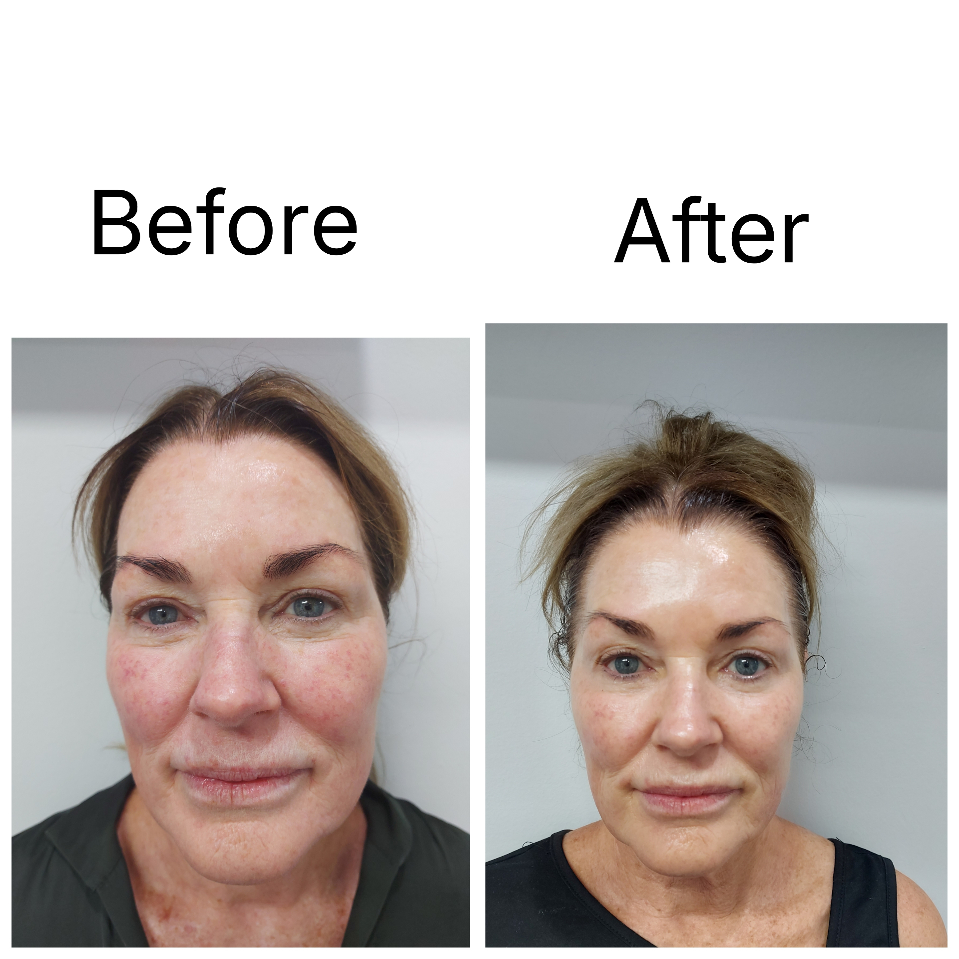 Before and after — Diamond Medi Spa client